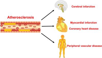 Anti-atherosclerosis mechanisms associated with regulation of non-coding RNAs by active monomers of traditional Chinese medicine